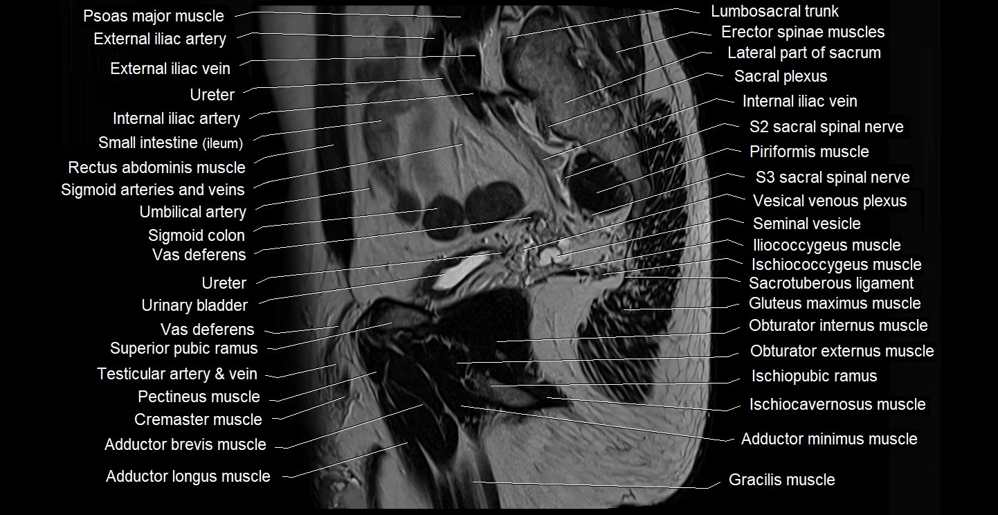 male pelvis sagittal cross sectional anatomy 3T mri image 15.webp